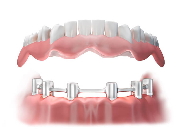 Benefits of Implant Supported Dentures