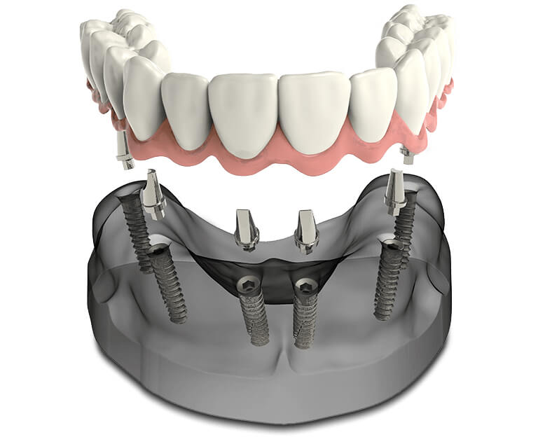 Benefits of Teeth-In-A-Day Dental Implants