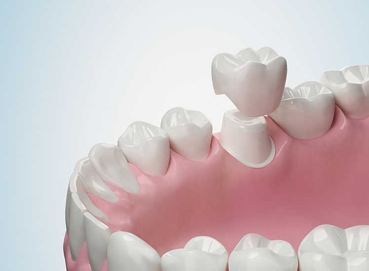 Dental Crown