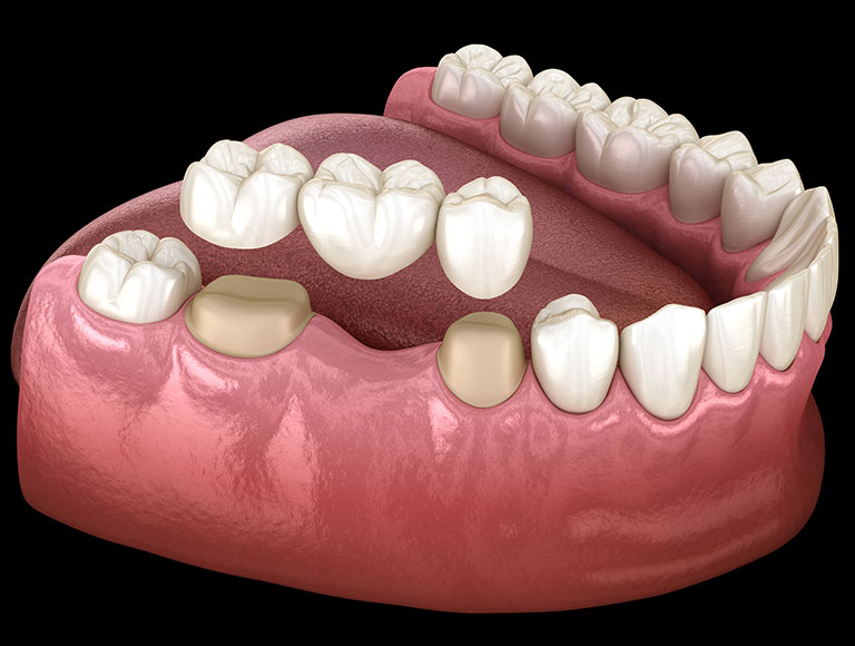 Dental Bridges