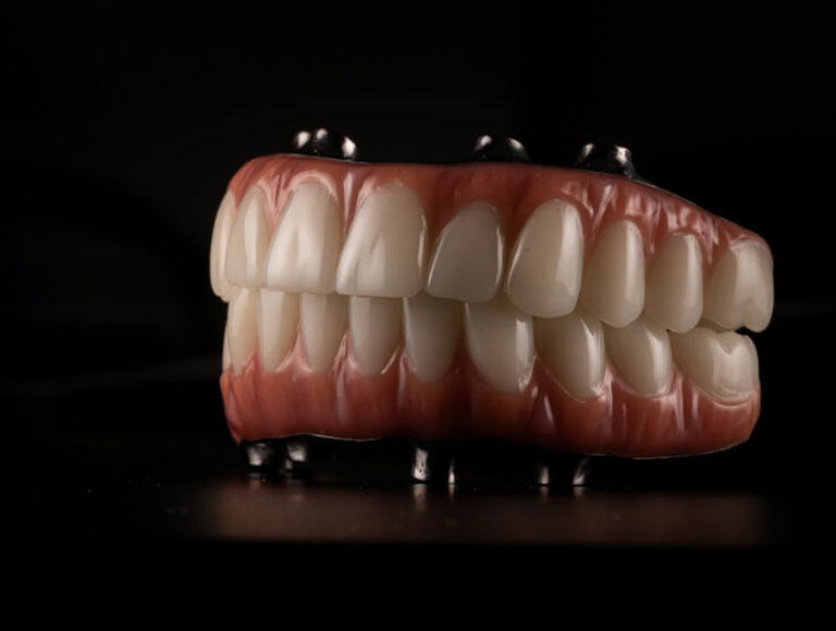 Investing In Dental Implants